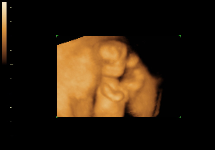 3D ultrasound image at 13 weeks